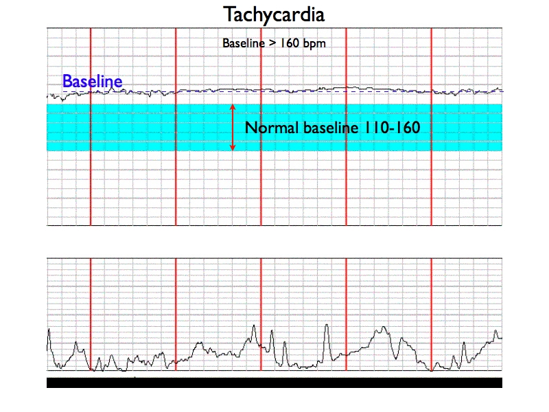 Histogram of baseline fetal heart rate values (A) Training data