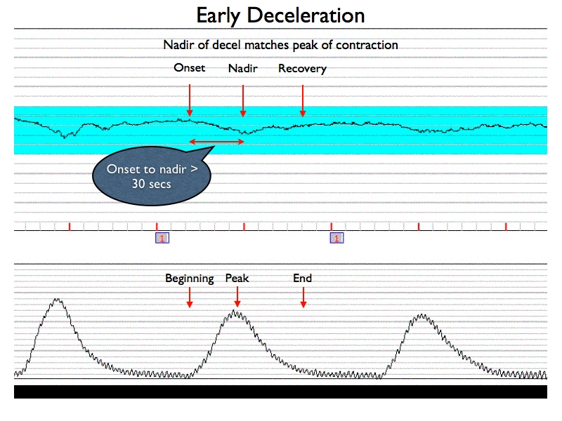 fhr acceleration