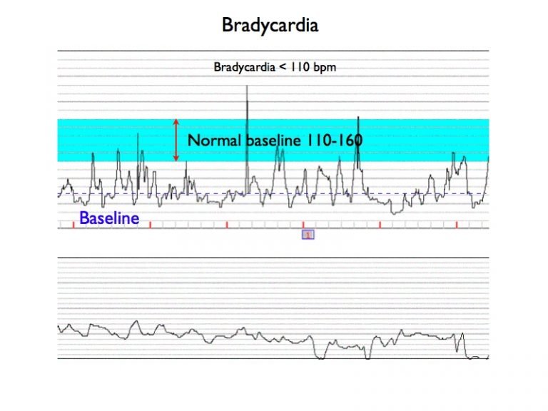 Basic Pattern Recognition – Electronic Fetal Monitoring