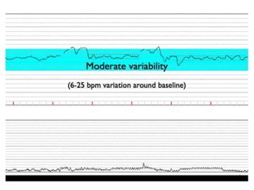 Basic Pattern Recognition – Electronic Fetal Monitoring