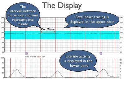 What fetal heart rate monitoring can – and can't – tell us
